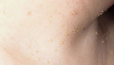 риск от развитие на папиломатоза на шията